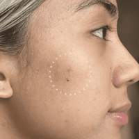 Mighty Patch™ for Dark Spots - Classic Style